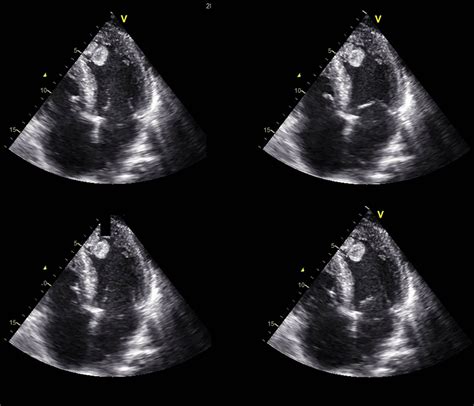 apex lv|Lv apex thrombus.